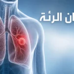 توضيح علمي لسرطان الرئة يظهر الرئتين وموضع الورم
