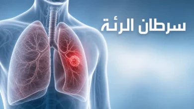 توضيح علمي لسرطان الرئة يظهر الرئتين وموضع الورم
