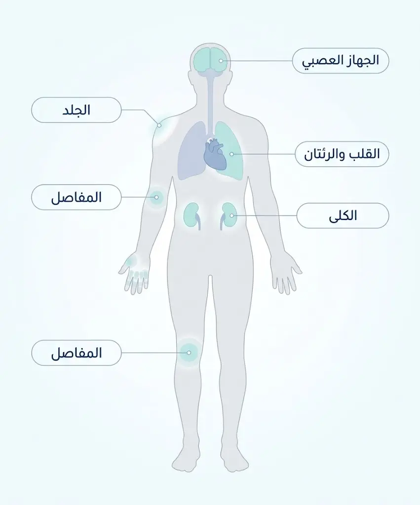 رسم توضيحي يبين الأعضاء الرئيسة التي قد تصيبها الذئبة الحمامية الجهازية في الجسم