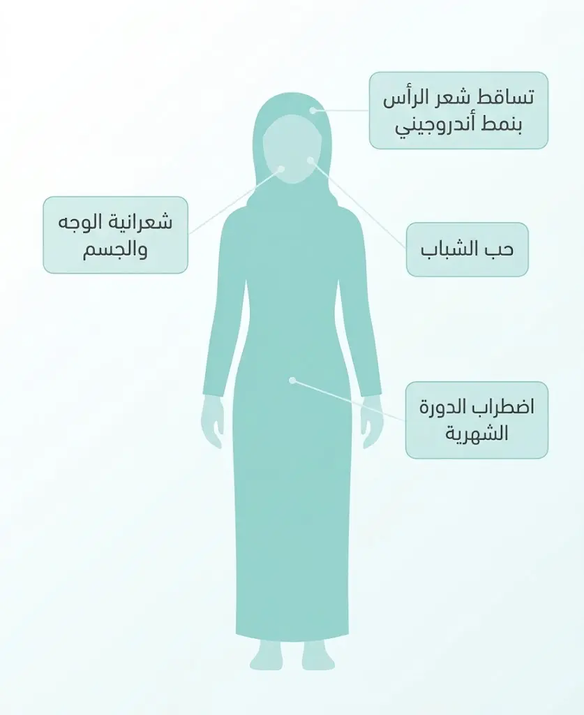  إنفوغرافيك يلخص أبرز أعراض متلازمة تكيس المبايض: تساقط الشعر، الشعرانية، حب الشباب، واضطراب الدورة