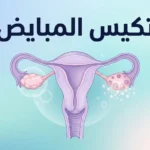 رسم توضيحي طبي لمتلازمة تكيس المبايض يوضح الجهاز التناسلي الأنثوي والمبيضين