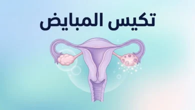 رسم توضيحي طبي لمتلازمة تكيس المبايض يوضح الجهاز التناسلي الأنثوي والمبيضين