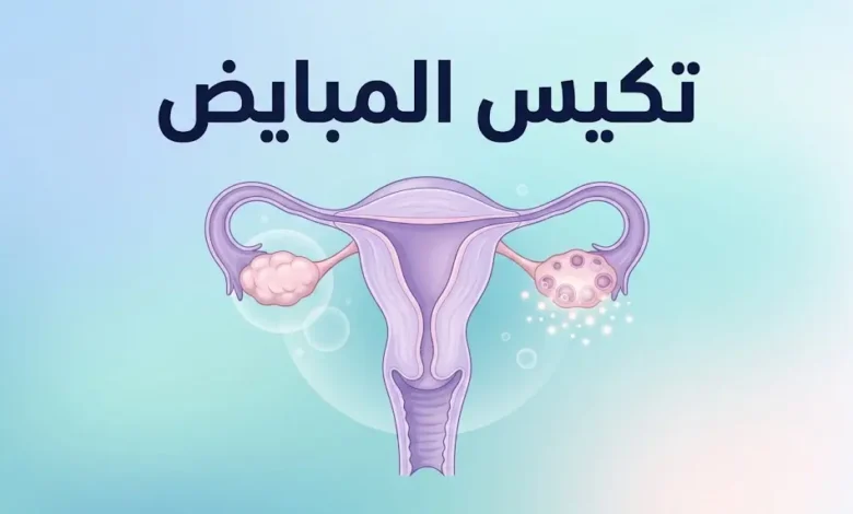 رسم توضيحي طبي لمتلازمة تكيس المبايض يوضح الجهاز التناسلي الأنثوي والمبيضين