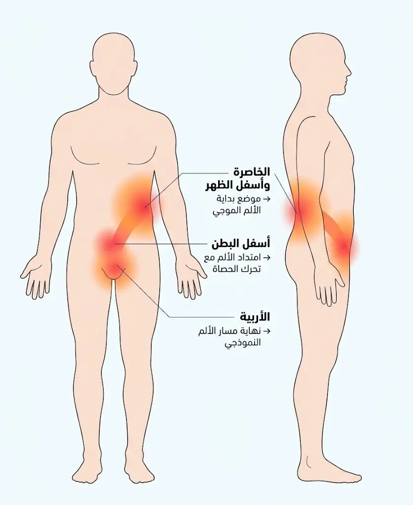 مخطط توضيحي يبيّن مسار انتشار ألم المغص الكلوي من الخاصرة إلى الأربية