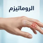 رسم طبي توضيحي ليد بشرية يُظهر مفاصل أصابع ملتهبة يرمز لأمراض الروماتيزم المختلفة.