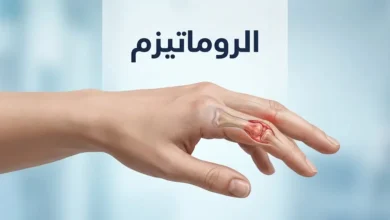 رسم طبي توضيحي ليد بشرية يُظهر مفاصل أصابع ملتهبة يرمز لأمراض الروماتيزم المختلفة.