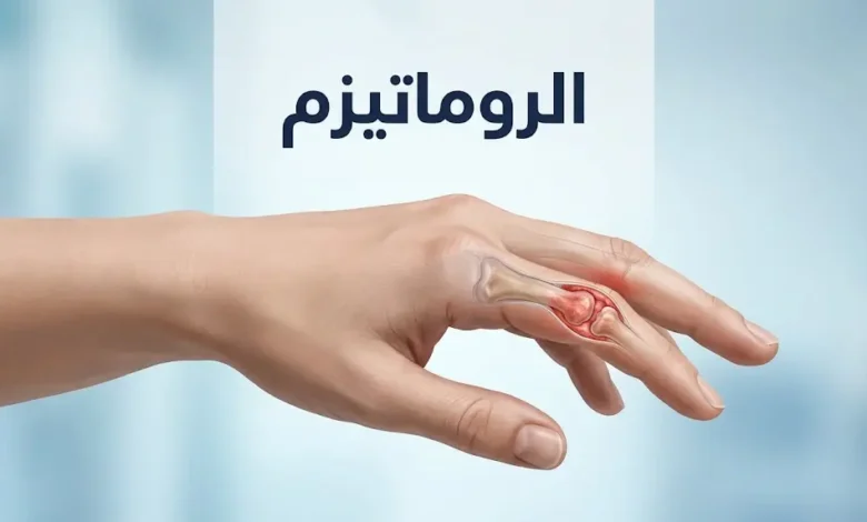 رسم طبي توضيحي ليد بشرية يُظهر مفاصل أصابع ملتهبة يرمز لأمراض الروماتيزم المختلفة.