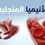 مقارنة بين كريات الدم الحمراء الطبيعية وكريات الدم المنجلية الشكل في مرض الأنيميا المنجلية