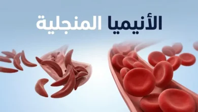 مقارنة بين كريات الدم الحمراء الطبيعية وكريات الدم المنجلية الشكل في مرض الأنيميا المنجلية