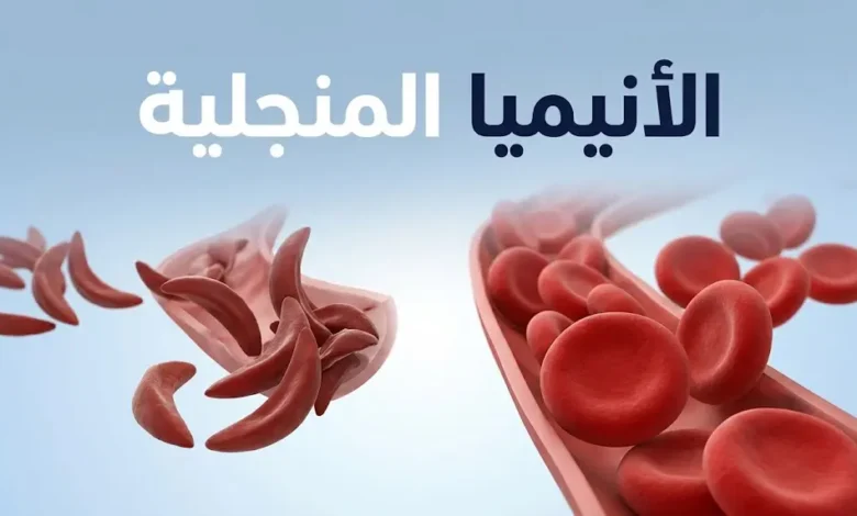 مقارنة بين كريات الدم الحمراء الطبيعية وكريات الدم المنجلية الشكل في مرض الأنيميا المنجلية