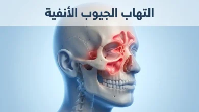 رسم تشريحي ثلاثي الأبعاد يوضح التهاب الجيوب الأنفية داخل الجمجمة