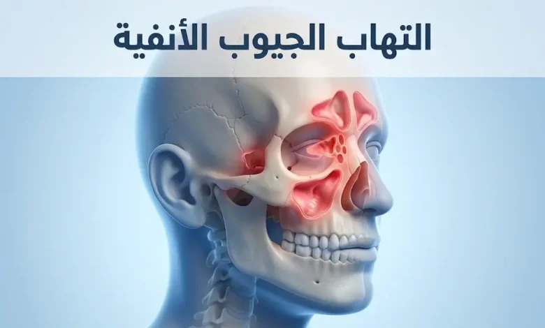 رسم تشريحي ثلاثي الأبعاد يوضح التهاب الجيوب الأنفية داخل الجمجمة