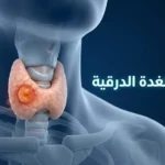 رسم ثلاثي الأبعاد واقعي يوضح موقع الغدة الدرقية في الرقبة مع عقدة غير طبيعية في أحد الفصين، يمثل موضوع سرطان الغدة الدرقية.