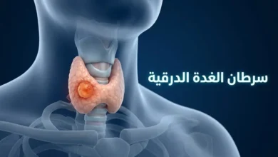 رسم ثلاثي الأبعاد واقعي يوضح موقع الغدة الدرقية في الرقبة مع عقدة غير طبيعية في أحد الفصين، يمثل موضوع سرطان الغدة الدرقية.