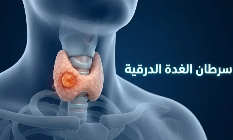 رسم ثلاثي الأبعاد واقعي يوضح موقع الغدة الدرقية في الرقبة مع عقدة غير طبيعية في أحد الفصين، يمثل موضوع سرطان الغدة الدرقية.