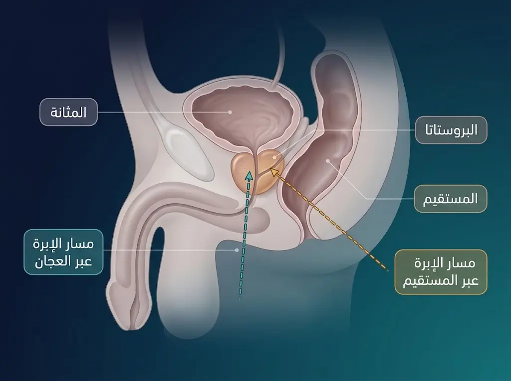 مخطط جانبي للحوض يقارن مسار إبرة خزعة البروستاتا عبر العجان ومسارها عبر جدار المستقيم